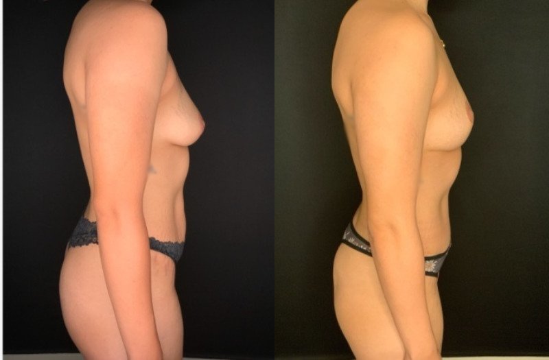 Patient #39145: Mommy Makeover Combine Image