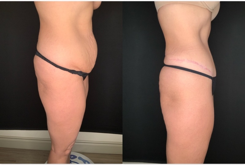Patient #19457: Tummy Tuck with Liposuction to Flanks After Image
