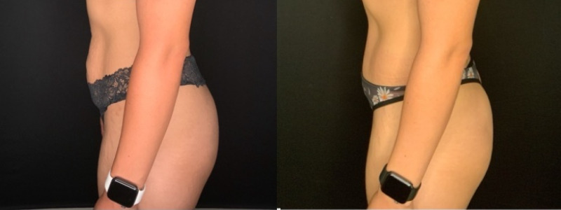 Patient #39145: Abdominoplasty with Liposuction to Flanks Combine Image