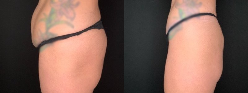 Patient #19457: Tummy Tuck with Liposuction to Flanks Combine Image