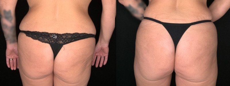 Patient #19457: Tummy Tuck with Liposuction to Flanks Combine Image