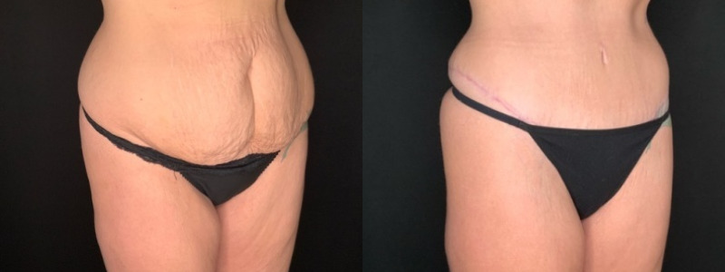 Patient #19457: Tummy Tuck with Liposuction to Flanks Combine Image