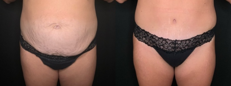 Patient #61879: Tummy Tuck with Hernia Repair Combine Image