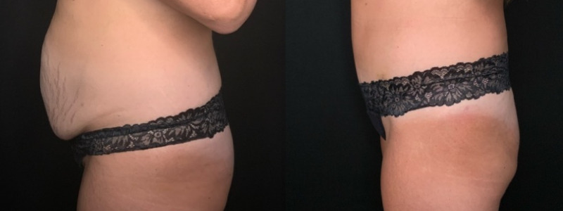 Patient #61879: Tummy Tuck with Hernia Repair Combine Image