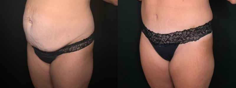 Patient #61879: Tummy Tuck with Hernia Repair Combine Image