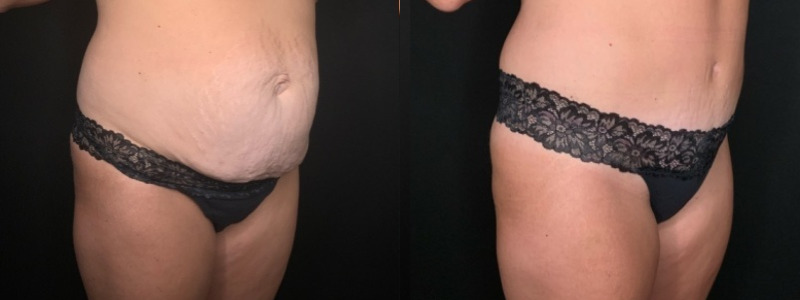 Patient #61879: Tummy Tuck with Hernia Repair Combine Image