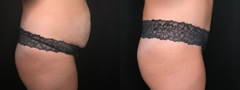 Patient #61879: Tummy Tuck with Hernia Repair Combine Image