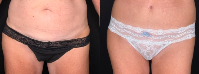 Patient #28469: Tummy Tuck with Liposuction to Flanks Combine Image
