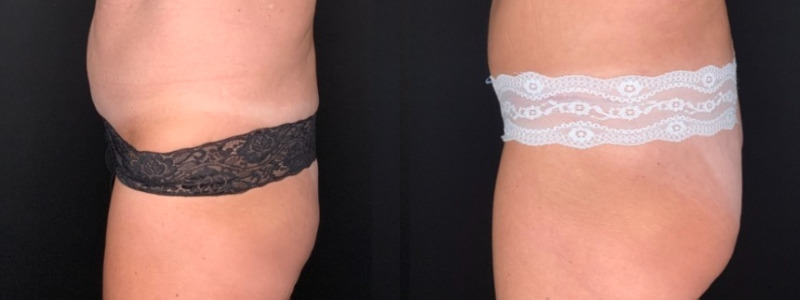 Patient #28469: Tummy Tuck with Liposuction to Flanks Combine Image