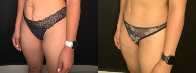 Patient #39145: Abdominoplasty with Liposuction to Flanks Combine Image
