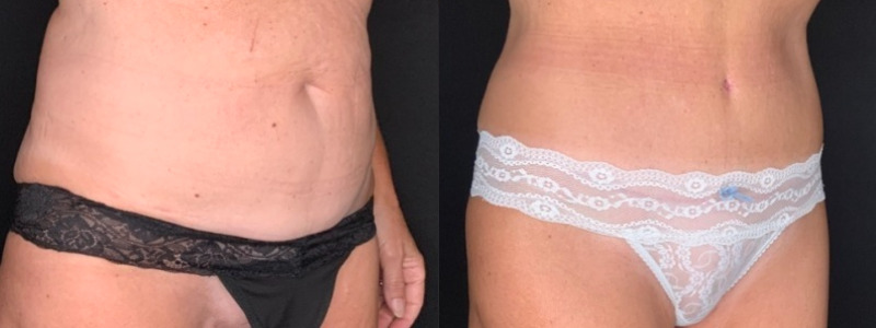 Patient #28469: Tummy Tuck with Liposuction to Flanks Combine Image
