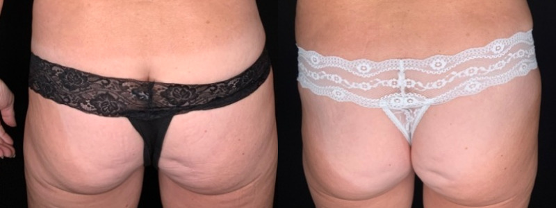 Patient #28469: Tummy Tuck with Liposuction to Flanks Combine Image