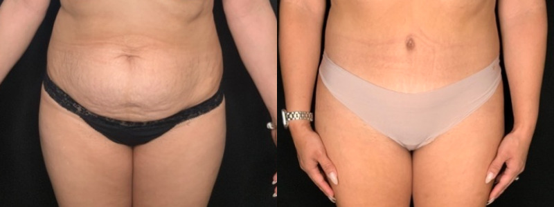 Patient #71654: Tummy Tuck with Liposuction to Flanks Combine Image