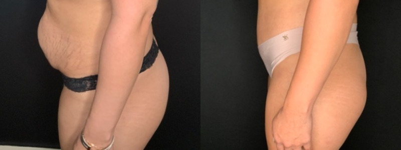 Patient #71654: Tummy Tuck with Liposuction to Flanks Combine Image