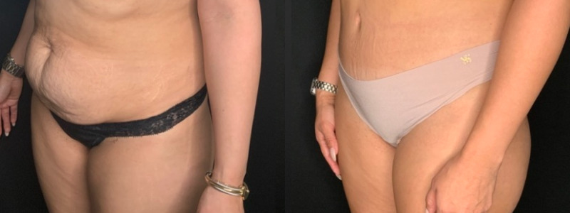 Patient #71654: Tummy Tuck with Liposuction to Flanks Combine Image