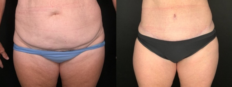 Patient #94214: Tummy Tuck with Liposuction to Flanks Combine Image