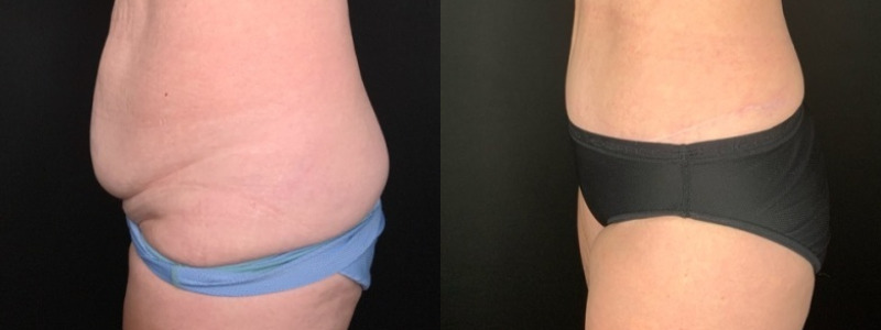 Patient #94214: Tummy Tuck with Liposuction to Flanks Combine Image