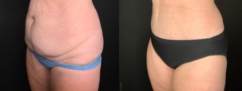 Patient #94214: Tummy Tuck with Liposuction to Flanks Combine Image