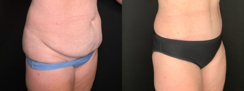 Patient #94214: Tummy Tuck with Liposuction to Flanks Combine Image