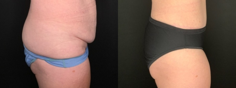 Patient #94214: Tummy Tuck with Liposuction to Flanks Combine Image