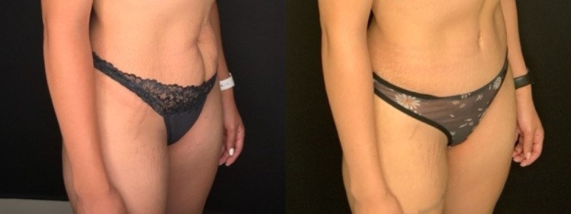 Patient #39145: Abdominoplasty with Liposuction to Flanks Combine Image