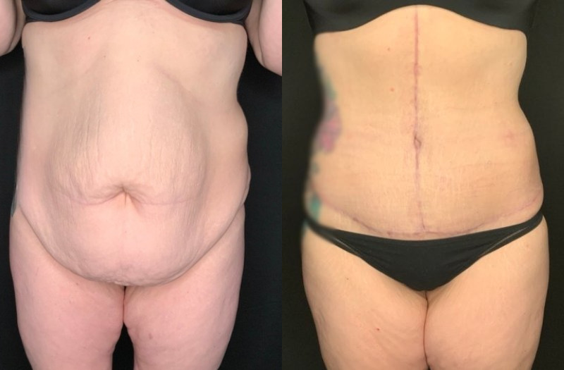Paciente #36478: Imagen combinada de abdominoplastia con flor de lis