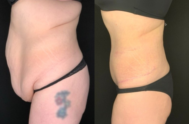 Paciente #36478: Imagen combinada de abdominoplastia con flor de lis