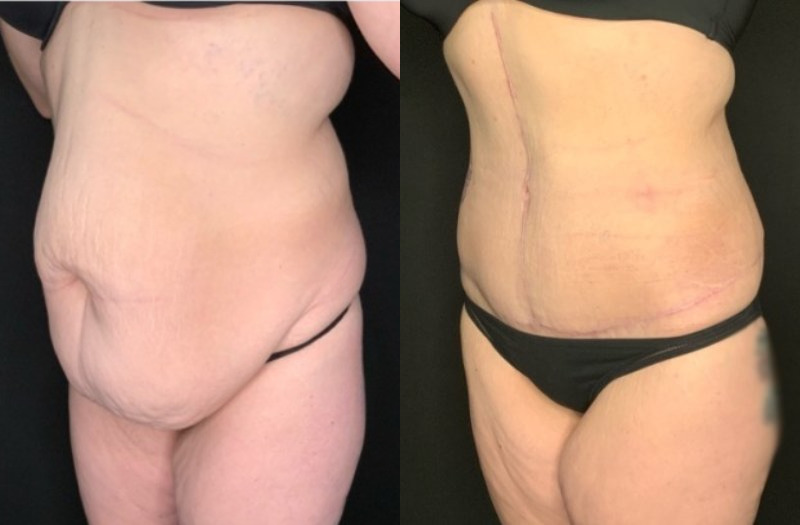 Paciente #36478: Imagen combinada de abdominoplastia con flor de lis