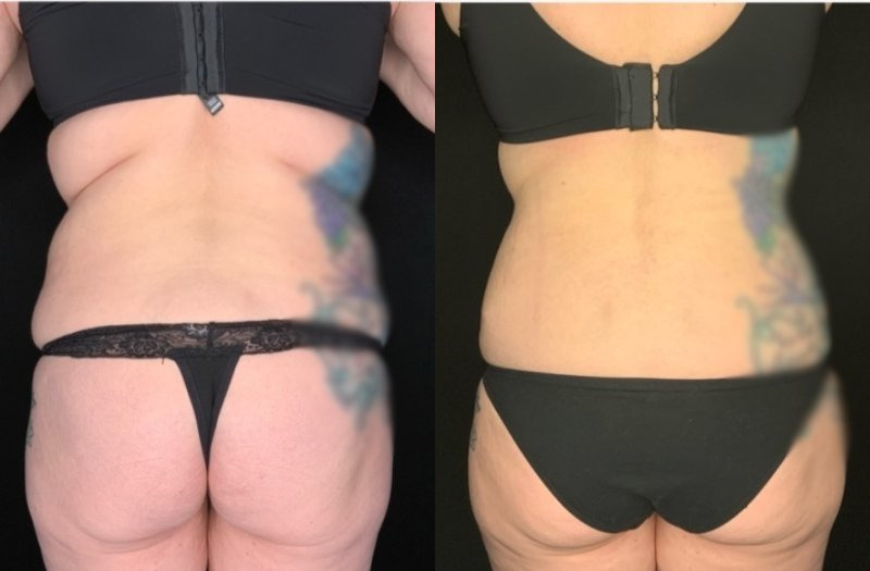 Paciente #36478: Imagen combinada de abdominoplastia con flor de lis