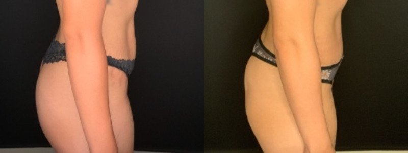 Patient #39145: Abdominoplasty with Liposuction to Flanks Combine Image