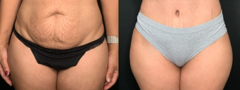 Paciente n.° 51674: Abdominoplastia con liposucción en los flancos (imagen combinada)