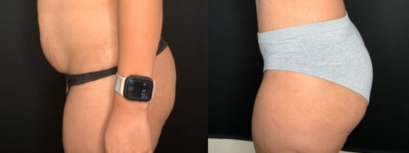 Paciente n.° 51674: Abdominoplastia con liposucción en los flancos (imagen combinada)