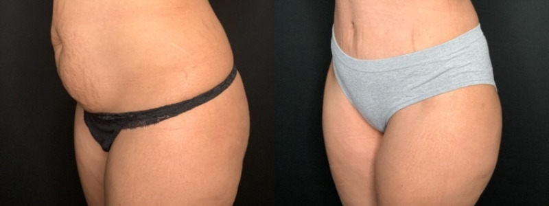 Paciente n.° 51674: Abdominoplastia con liposucción en los flancos (imagen combinada)