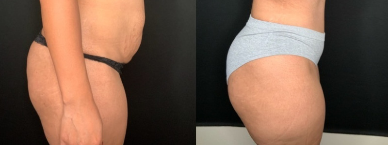 Paciente n.° 51674: Abdominoplastia con liposucción en los flancos (imagen combinada)