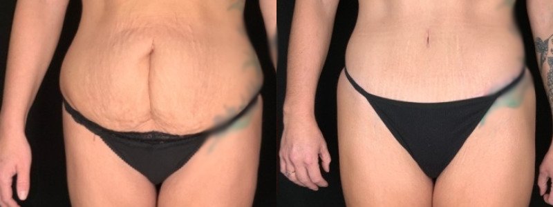 Patient #19457: Tummy Tuck with Liposuction to Flanks Combine Image