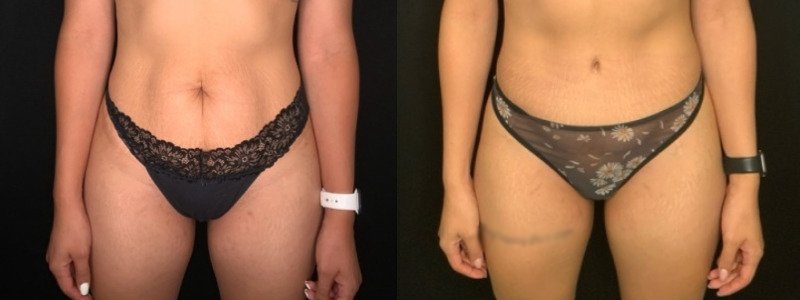 Patient #39145: Abdominoplasty with Liposuction to Flanks Combine Image