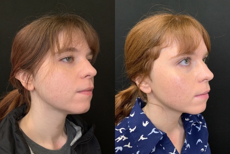 Patient #34879: Sofwave to Jawline Combine Image