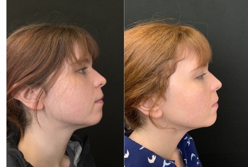 Patient #34879: Sofwave to Jawline Combine Image