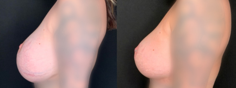 Patient #49627: Breast Implant Exchange with Lift and Capsulorrhaphy Combine Image