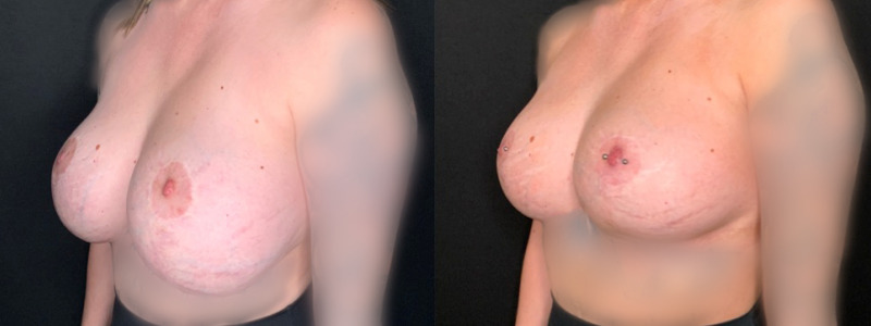 Patient #49627: Breast Implant Exchange with Lift and Capsulorrhaphy Combine Image