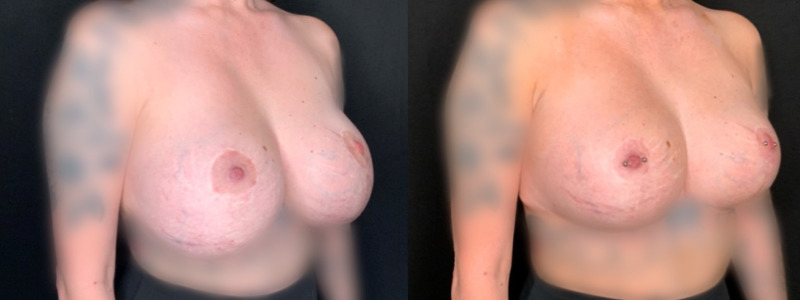 Patient #49627: Breast Implant Exchange with Lift and Capsulorrhaphy Combine Image
