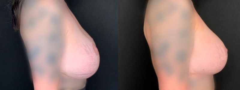 Patient #49627: Breast Implant Exchange with Lift and Capsulorrhaphy Combine Image