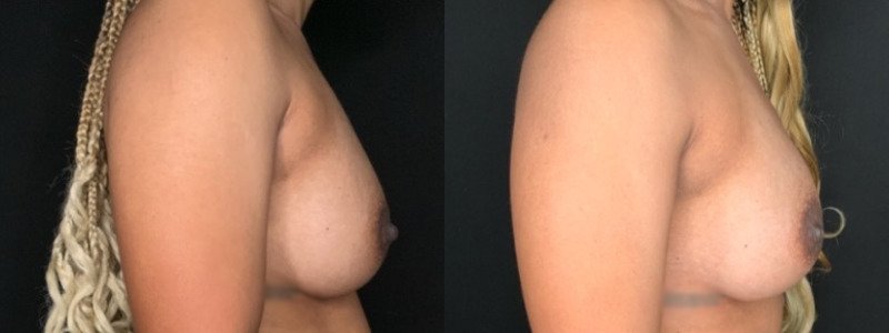 Patient #68942: Breast Implant Exchange with Capsulectomy Combine Image