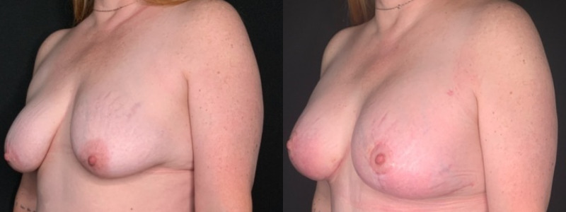 Patient #54677: Breast Lift with Implants Combine Image