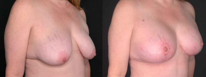 Patient #54677: Breast Lift with Implants Combine Image