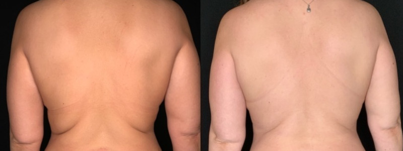Patient #35811: Breast Reduction Combine Image