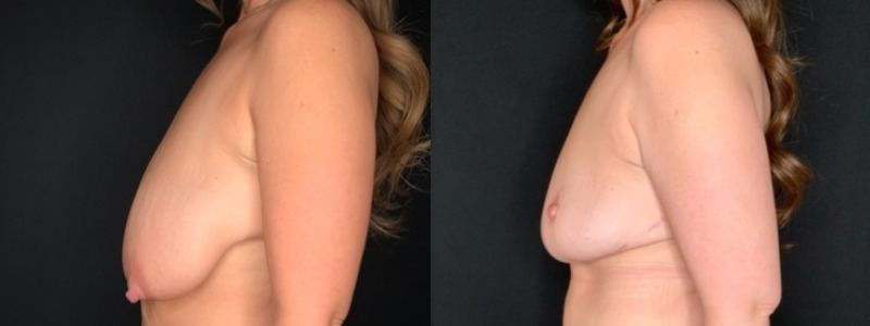 Patient #35811: Breast Reduction Combine Image