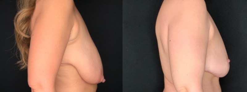 Patient #35811: Breast Reduction Combine Image