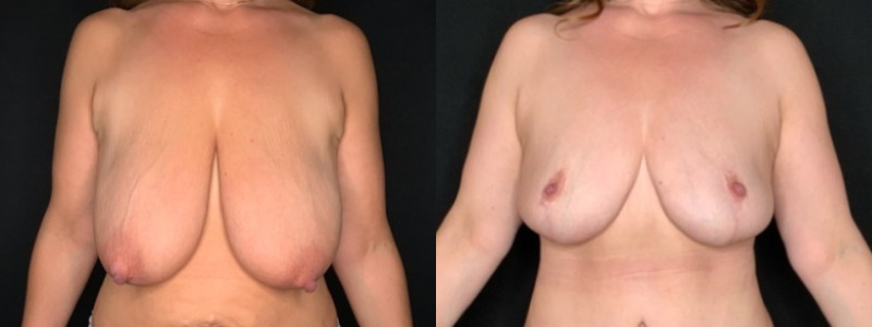 Patient #35811: Breast Reduction Combine Image