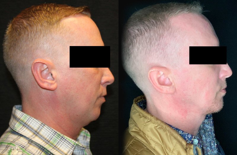 Patient #32637: FaceTite with Liposuction & Morpheus Combine Image